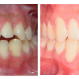 Doctor-Carlos-Sejnaui-Casos-Clinicos-Ortodoncia-en-Cali 12