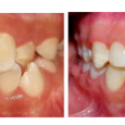 Doctor-Carlos-Sejnaui-Casos-Clinicos-Ortodoncia-en-Cali 17