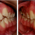 Doctor-Carlos-Sejnaui-Casos-Clinicos-Ortodoncia-en-Cali 25