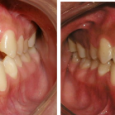 Doctor-Carlos-Sejnaui-Casos-Clinicos-Ortodoncia-en-Cali 4