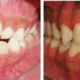 Doctor-Carlos-Sejnaui-Casos-Clinicos-Ortodoncia-en-Cali 6