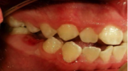 Agenesias o falta de dientes - Sejnaui Ortodoncia