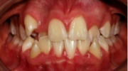 Dientes Atrapados - Sejnaui Ortodoncia