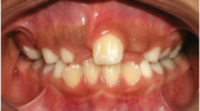 Dientes retenidos - Sejnaui Ortodoncia