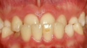 Mordida Cruzada Anterior - Sejnaui Ortodoncia