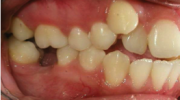 Perdida Temprana de Dientes - Sejnaui Ortodoncia