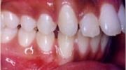 Protusion Dental - Sejnaui Ortodoncia